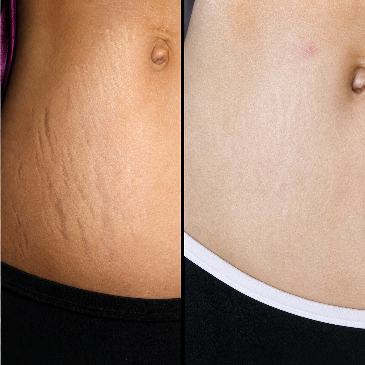 Crema Correctora de Estrías y Marcas
